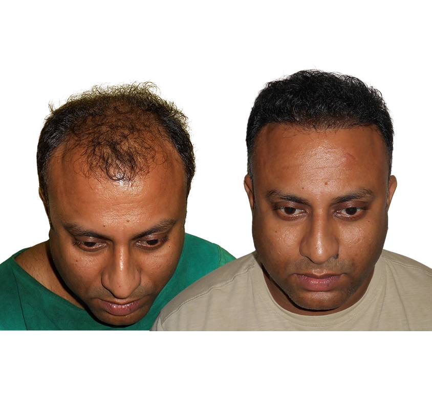 hair transplant clinic in kolkata 