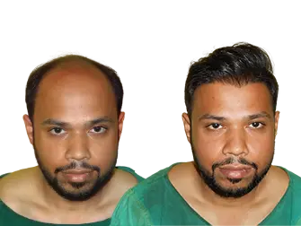 hair transplant before and after images